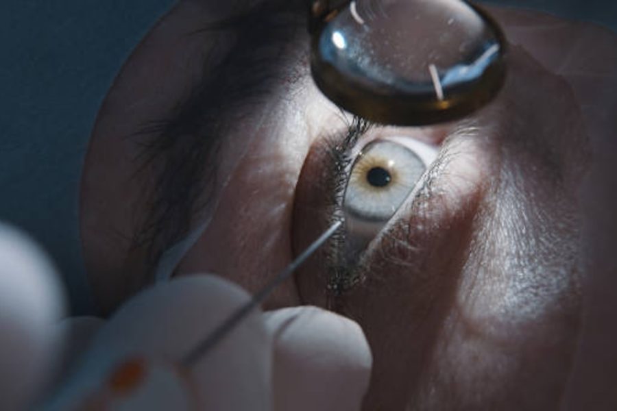 Cataract Surgery