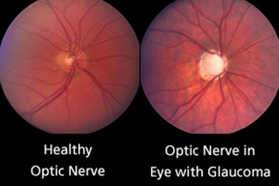 Glaucoma