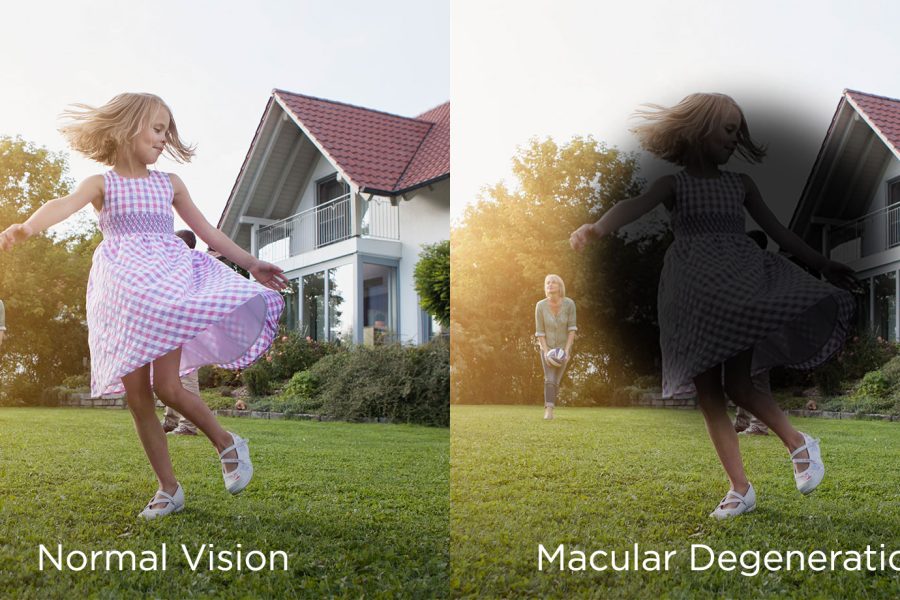 Macular Degeneration